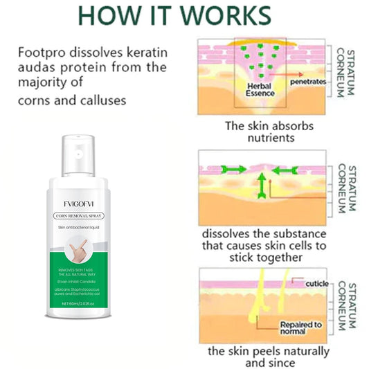 Corn Removal Spray 60ml Pack of 1